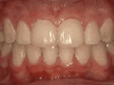 Crowded Teeth — after