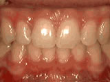 Deep Overbite — Lower Front Teeth Bite Into Palate — after
