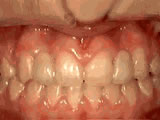 Missing Incisors — after