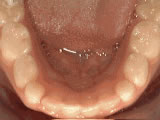 Treatment Without Braces — after