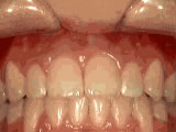 Open Bite — Front Teeth Don't Touch — after