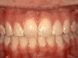 Overjet — Protruding Front Teeth — after