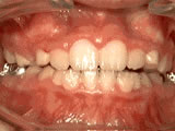 Phase-One Treatment — after
