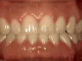 Spaced-Out Teeth — after