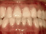 Underbite — Lower Front Teeth In Front of the Upper Teeth — after